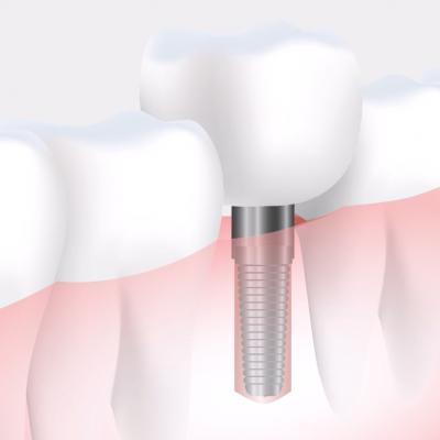 Zahn-Implantat-Tag 2017